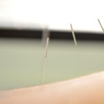 Hogyan segíthet az akupunktúra endometriózis esetén?